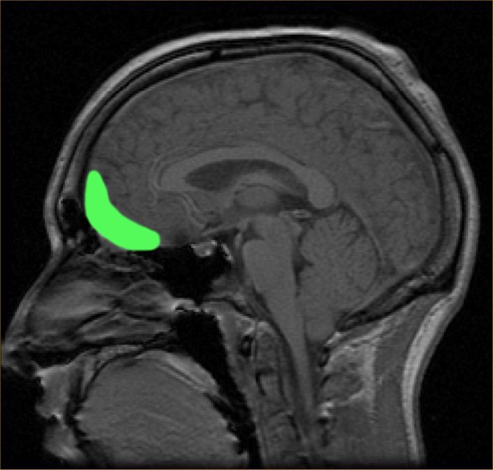 Her ses en hjerne, som er MRI-scannet i 2003. Det lysende, grønne felt er orbitofrontal cortex. Det er her, hvor håbet blandt andet residerer.